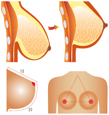 Breast Uplift